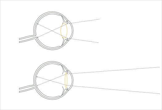 Accommodation: illustration of adjusted lens curvature.